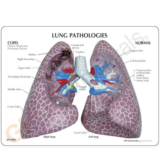 Diseased Lung Model (COPD, Cancer, Asthma)