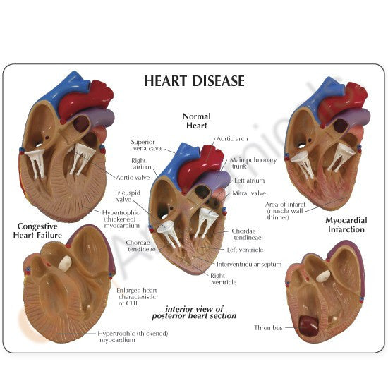 Heart Disease Model (3 part)