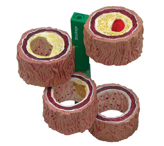 Atherosclerosis Artery Anatomical Model, 4 part on stand - 2650