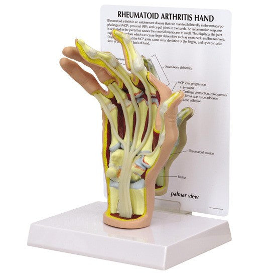 Rheumatoid Arthritis (RA) Hand Model 1931