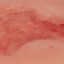 Small Wound Moulage Venous Leg Ulcer in Epithelisation Phase - PW002C