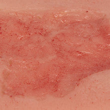 Small Wound Moulage Arterial Leg Ulcer in Epithelisation Phase PW004C