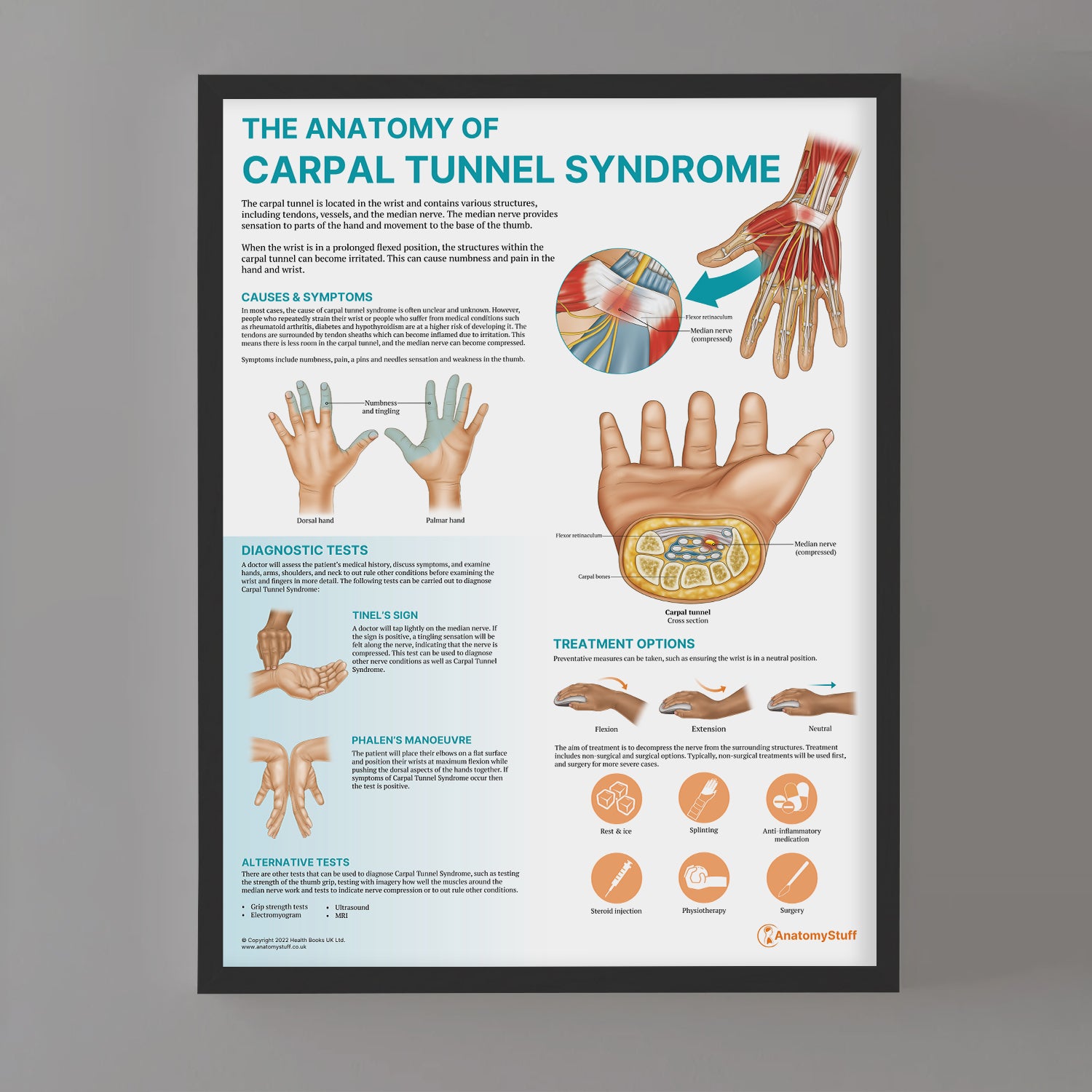 The Anatomy of Carpal Tunnel Syndrome Chart / Poster