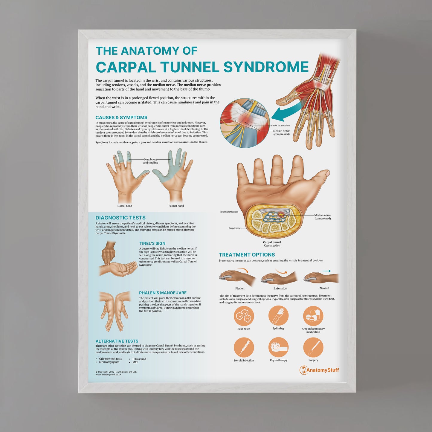 The Anatomy of Carpal Tunnel Syndrome Chart / Poster